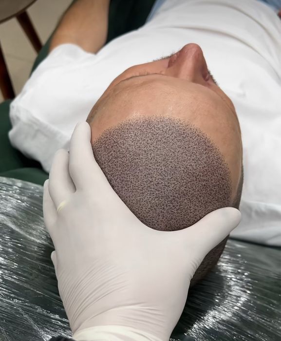 Micropigmentare scalp tricopigmentare efect indesire par alopecie SMP