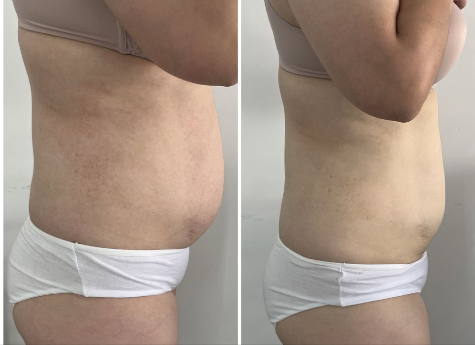 Ультраформер, косметологический аппарат