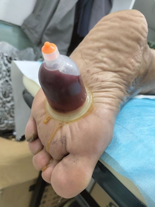 тиббий зулуклар медицинский пиявки гирудотерапия