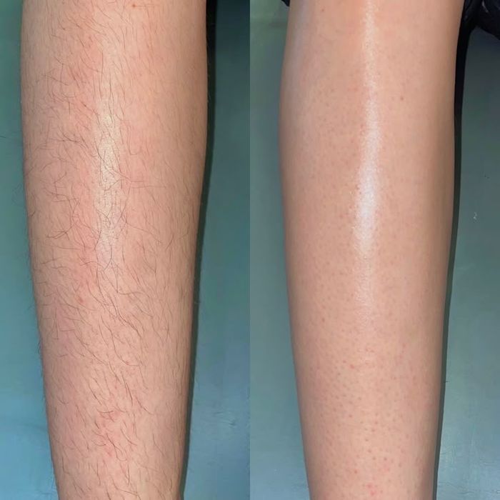 Акция Шугаринг бикини 4000