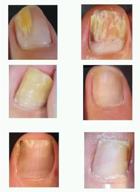 Проблемы с ногами (стопами) и ногтями