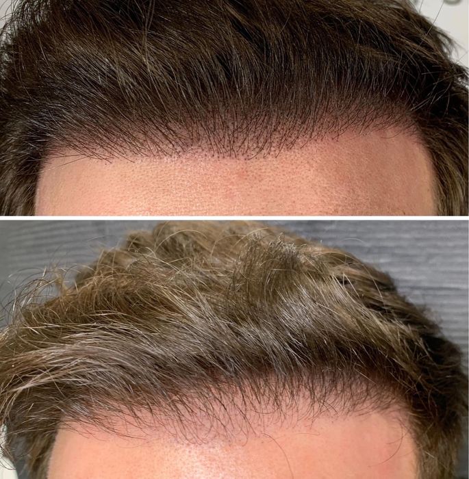 Micropigmentare scalp si barba indesire par tatuaj alopecie chelie