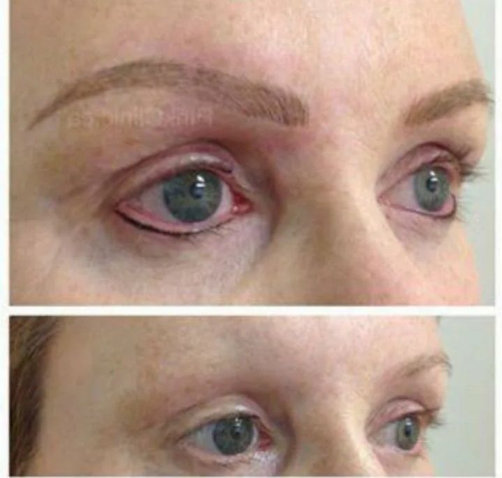 Удаление лазером тату от 5000