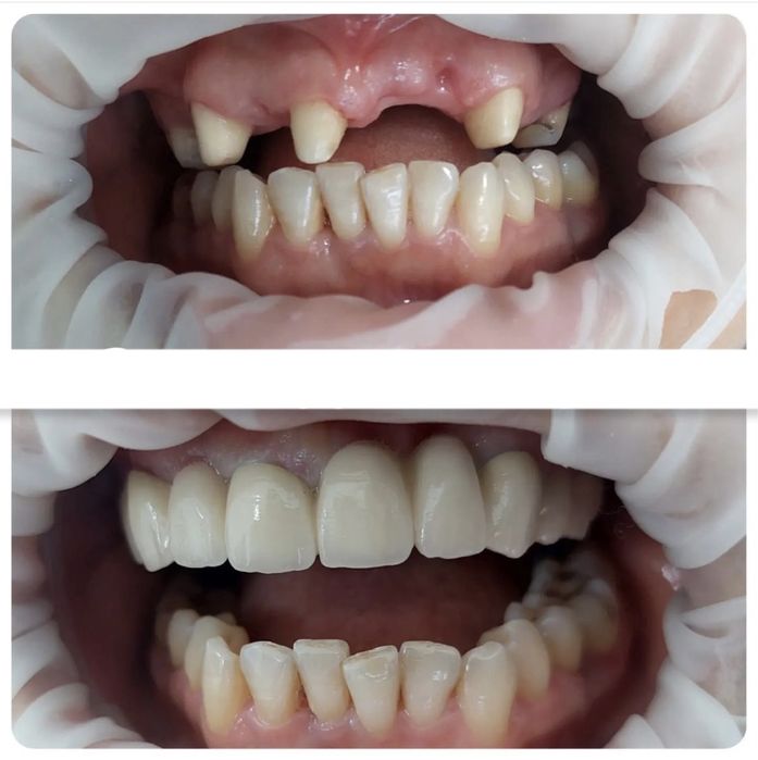 Металлокерамика . Зубные коронки.