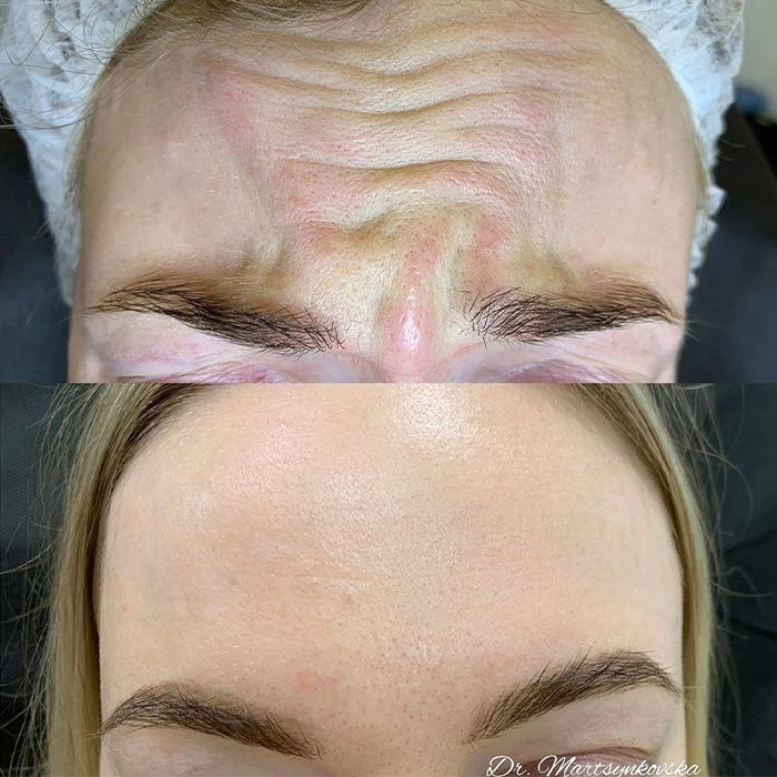 Ботулинотерапия (ботокс) межбровка, морщинки на лбулбу