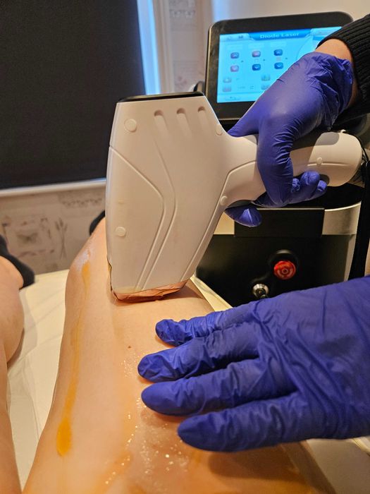 Epilare definitiva laser 4 lungimi unda