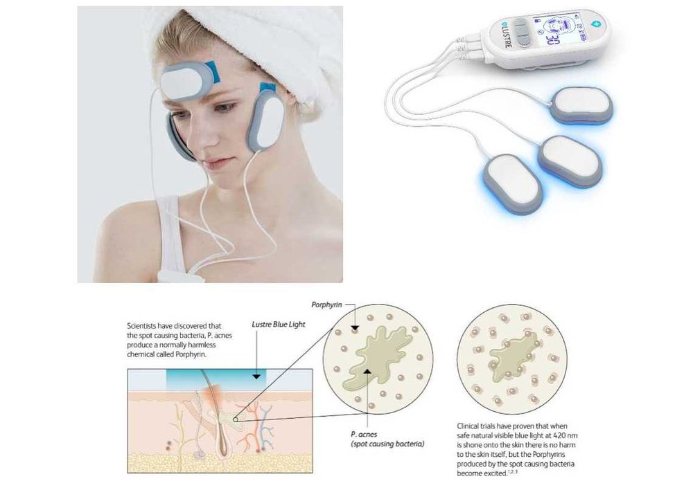 Сбогом АКНЕ! Уред срещу акне LUSTER Pure Light Pro