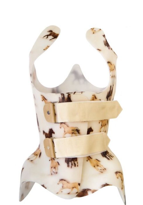 Корсет Шено 3д при сколиозе