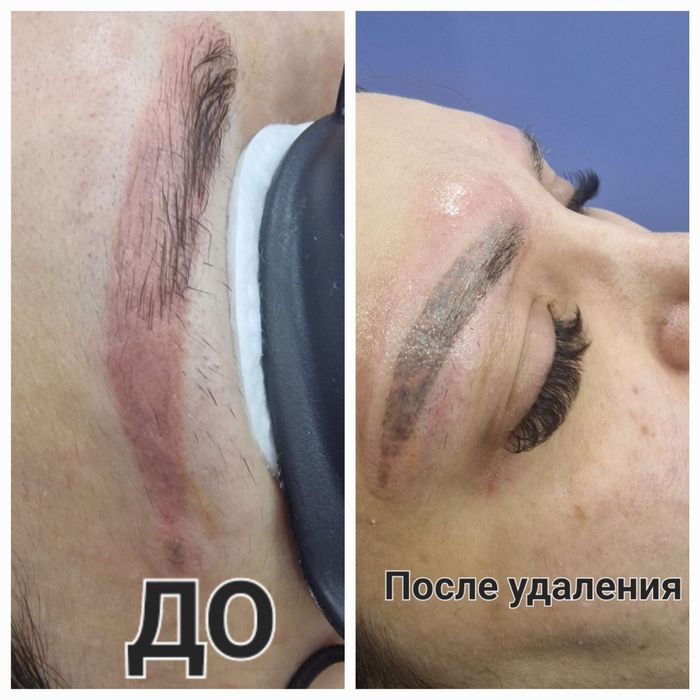 Удаление татуировок  и татуажа