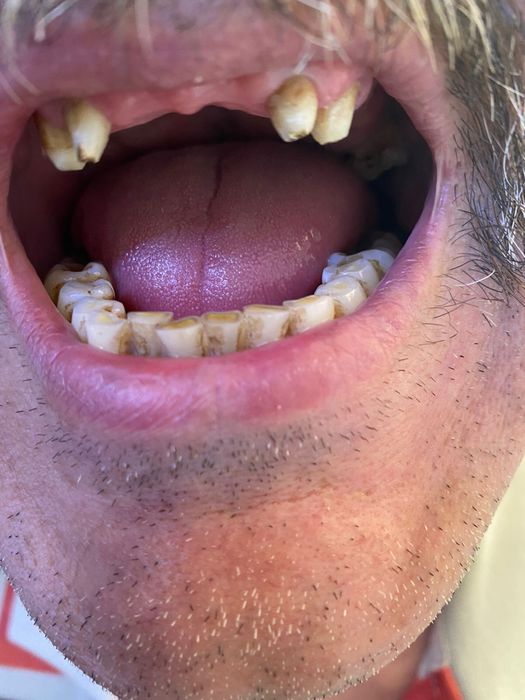 Протезы ,Циркон, Керамика , Виниры!