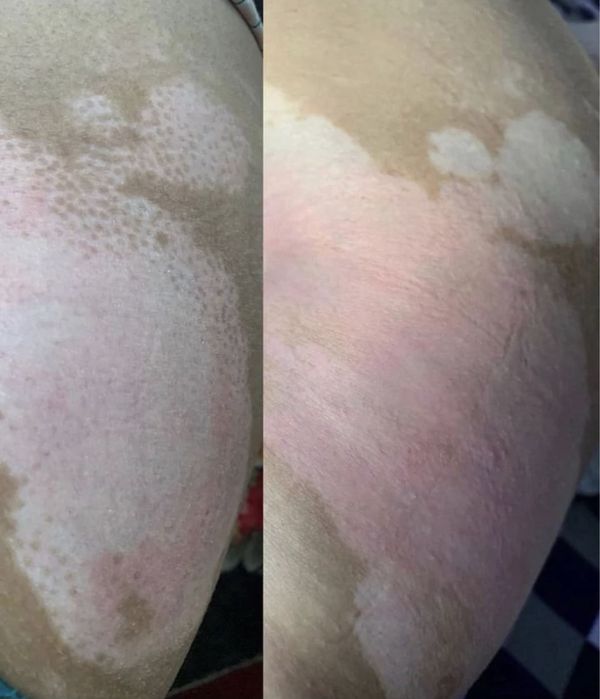 311 нм лампа  (UVB- Philips) витилиго, псориаз даволовчи лампа