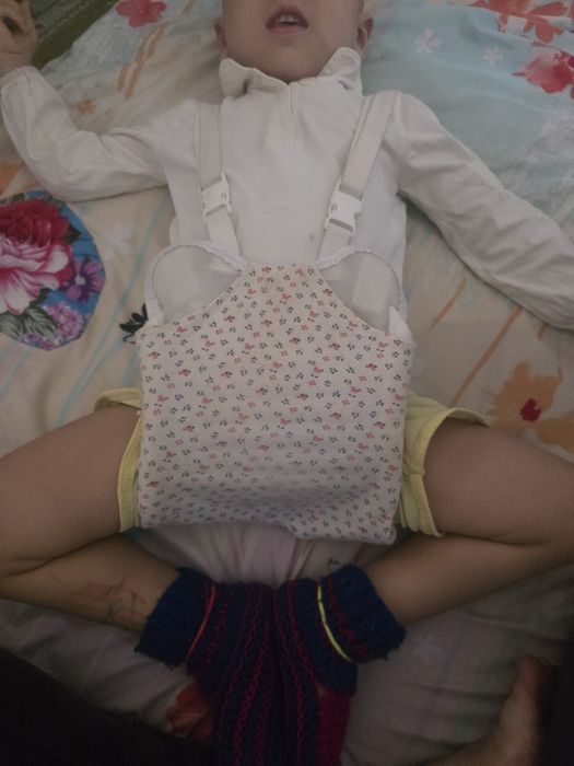 Шина Фрейка для лечения дисплазии