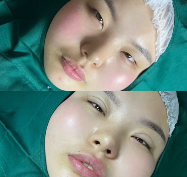 Нитевая блефаропластика