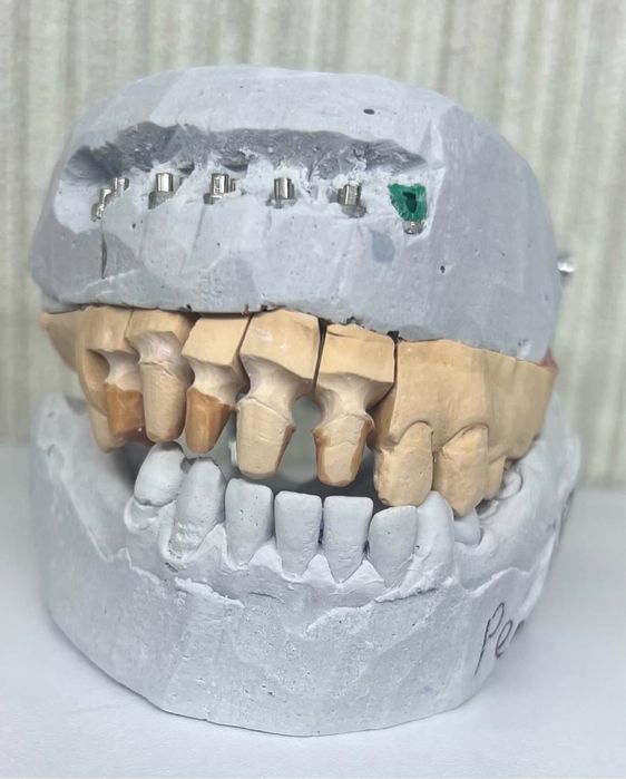 Цирконий / E-max за 2–3 дня | Luminora Dental