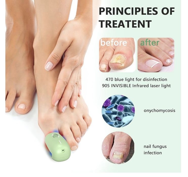 Dispozitiv de tratament cu laser pentru ciuperca unghiilor iKeener