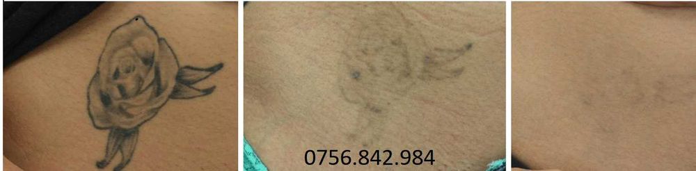 Arad-Eliminare tatuaj cu laser, preturi de la 100 ron