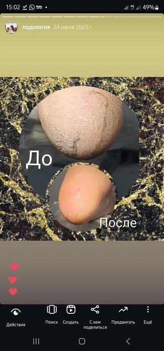 Педикюр титановая нить подолог