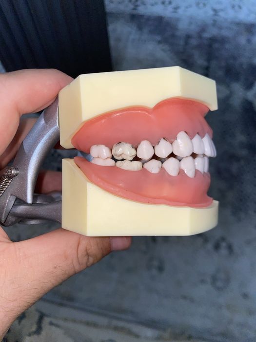 Arcadă dentară cu boală parodontală și tartru