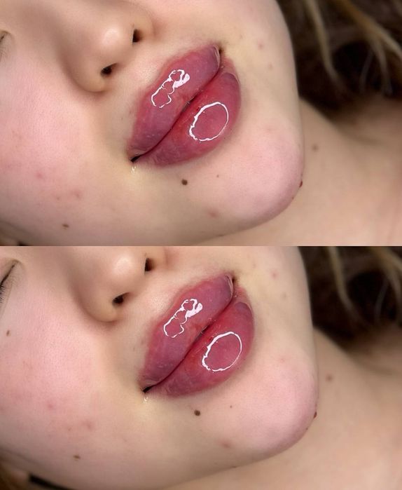 Labga filler qoʻydik 1 ml