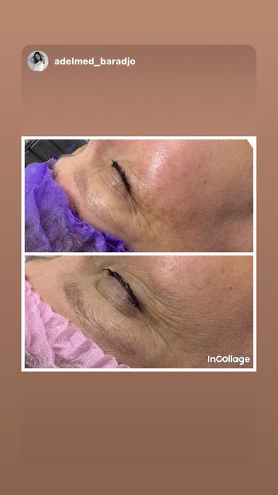 Косметолог Ботокс Низкие Цены