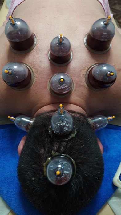 Хиджама. Шертпе. Пиявки