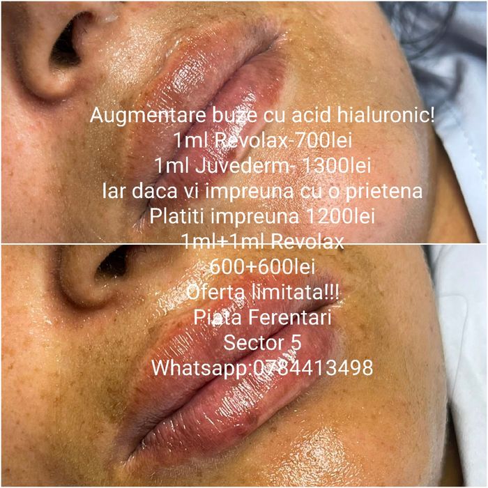 Oferta augmentare buze cu acid hialuronic!!!