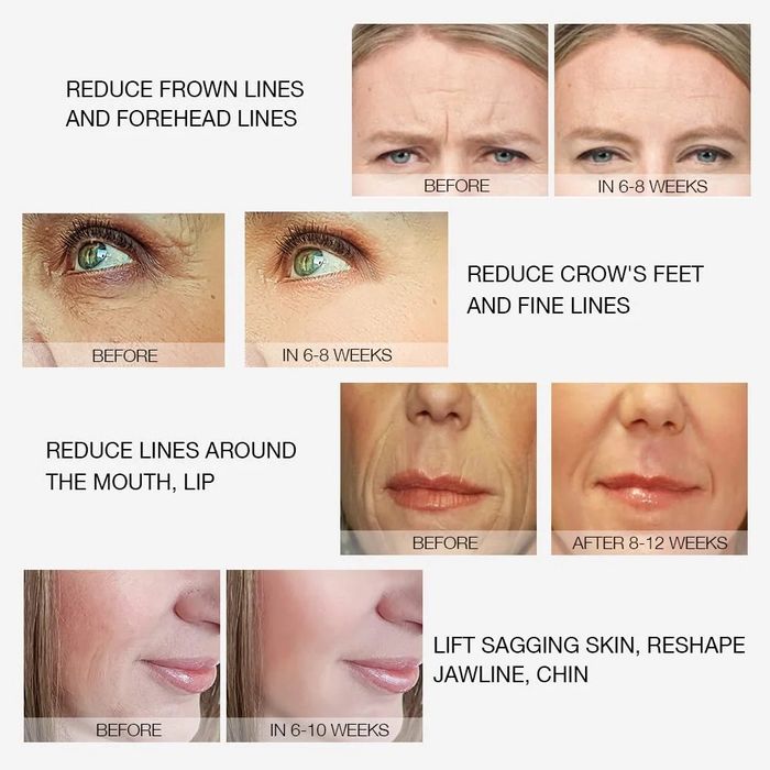 Радиочестотен лифтинг машина