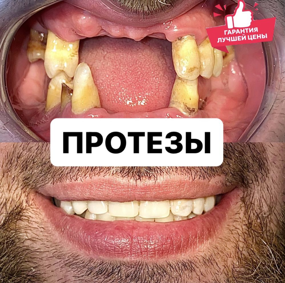Протезы. Съёмные протезы. Зубные Протезы. Стоматология протезы ...