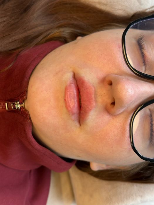 Контурная пластика губ