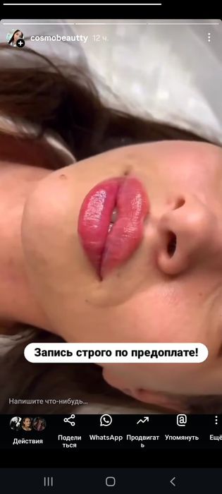 Увеличение губ -24900