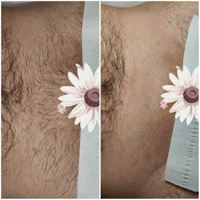 Sugaring , epilare cu zahar, depilare pentru femei si barbati