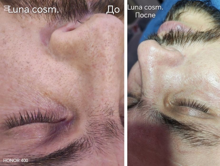 чистка лица , пилинг, лечение акне