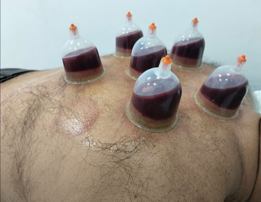 тиббий зулуклар медицинский пиявки гирудотерапия