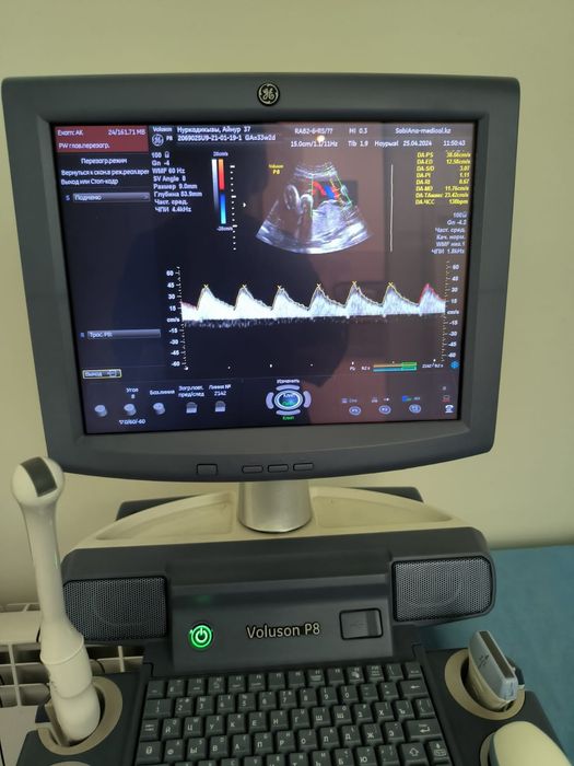 Уз аппарат Волюсон Р8