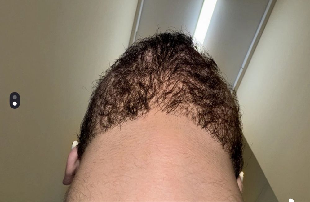 Soch va soqol o'stiradigan losyon