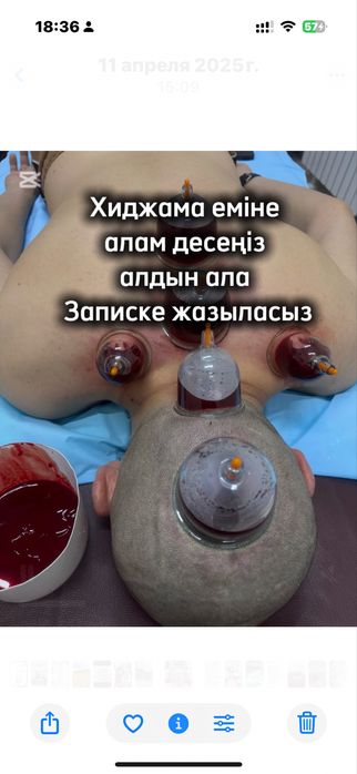 Хиджама, Пиявки Массаж емдері