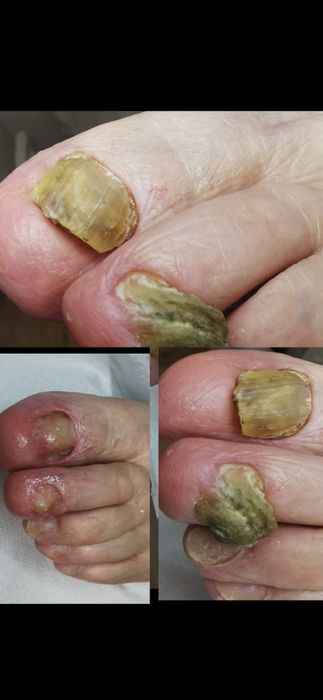 Cabinet pedichiura complexa /onicomicoze /unghii încarnate Alb