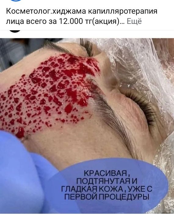 хиджама профессионально.опыт 10 лет