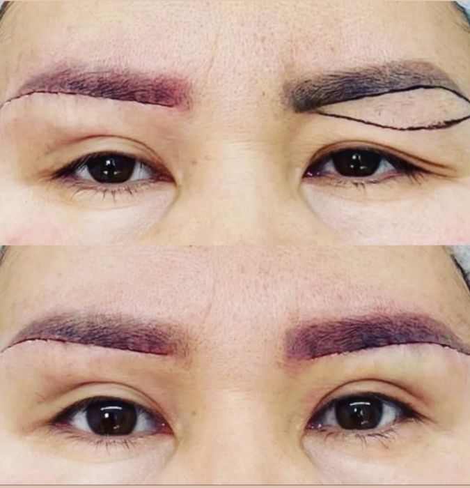 -50% CHEGIRMADA Qovoqlar Blefaroplastikasi