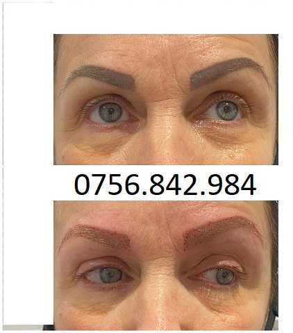 Arad-Eliminare tatuaj cu laser, preturi de la 100 ron