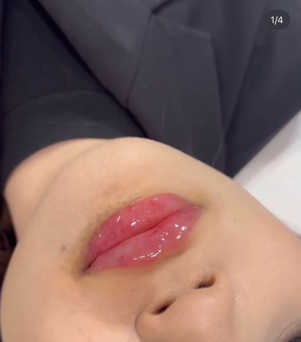 Увеличение губ 25000тг