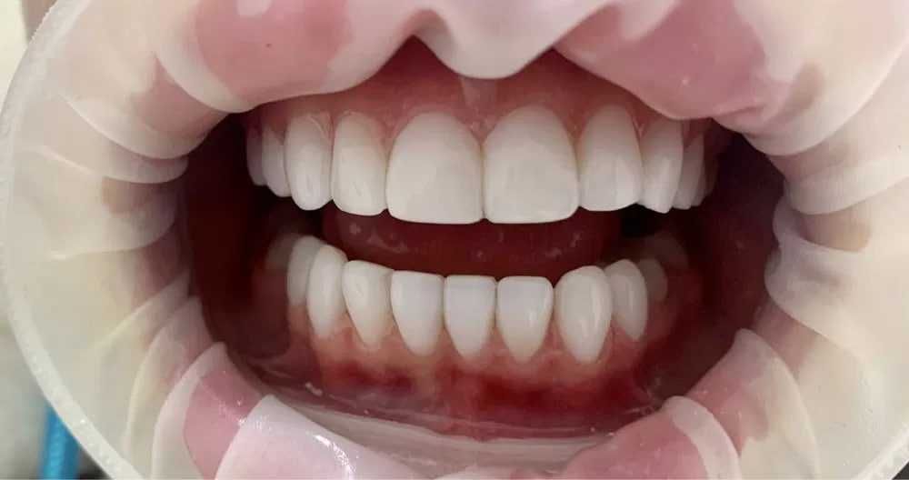 CAD/CAM технология – зубного техника за одно посещение