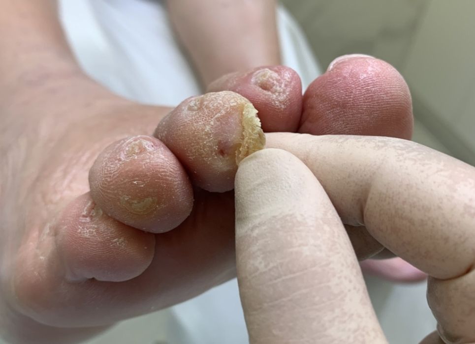 Квалифицированная помощь подолога.