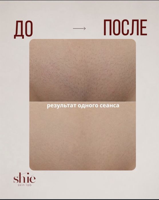 Шугаринг с сахаром комплекс 4000 и лазер