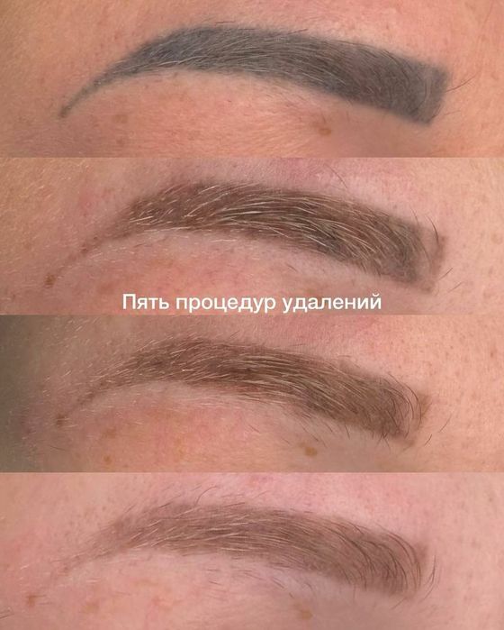 Удаление ремувером  старого перманента 200.000