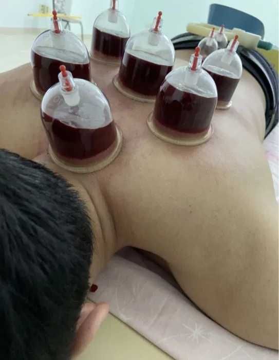 Хиджама. Шертпе. Кровопускание