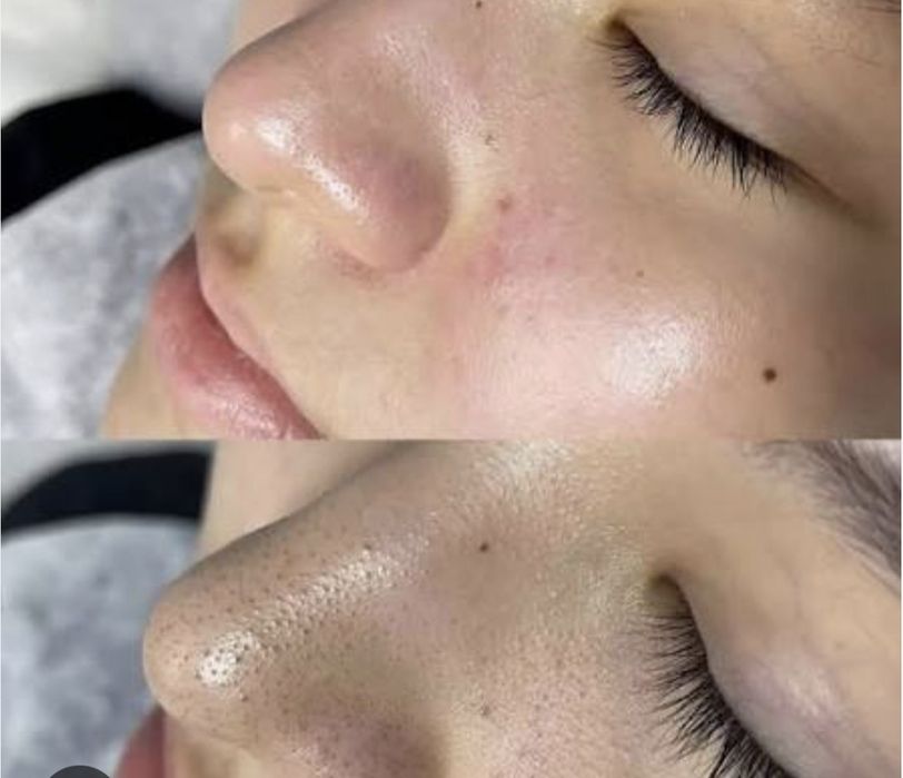 Акция по 250 тысяч Чистка лица ПилингКарбокситерапия механическая чист