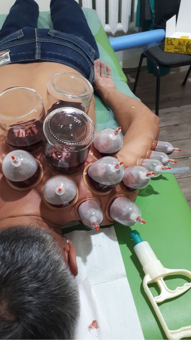 Хиджама и шертпе на выезд в городе Алматы