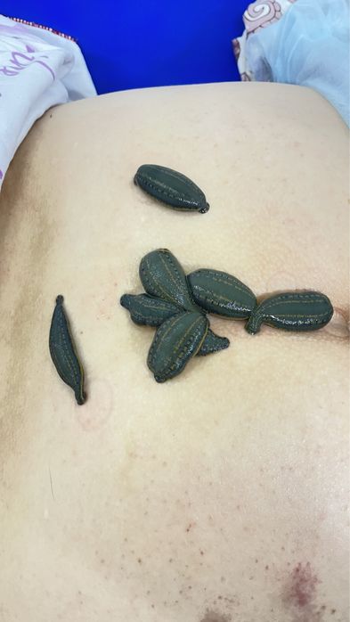 Лечение пиявками, сүлікпен емдеу