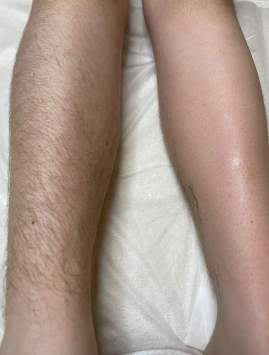 Шугаринг всего тела